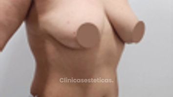 Mastopexia - Dr. Nadir Carda