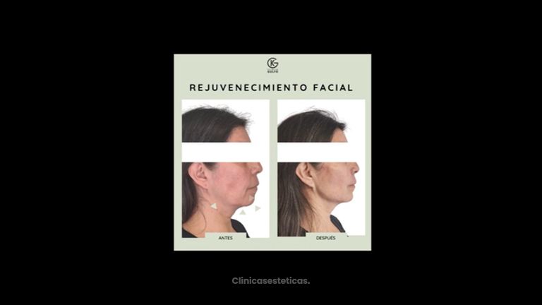 Rejuvenecimiento facial - Clínica Dra. Kelly Gulfo