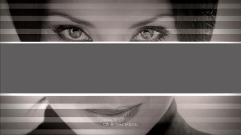 Blefaropastia - Doctor Patricio Stevens Moya