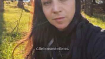Rinoplastia Ultrasonica - Dra. Angélica Sifontes Muñoz