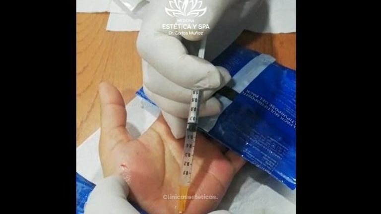 Botox para Hiperhidrosis