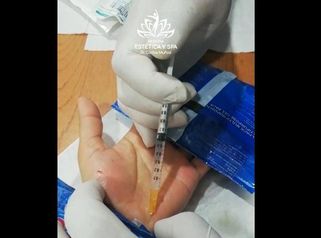 Botox para Hiperhidrosis