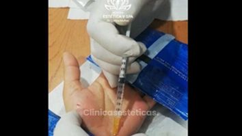 Botox para Hiperhidrosis