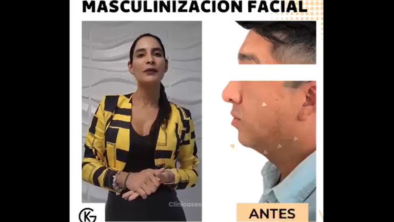 Masculinización facial - Clínica Dra. Kelly Gulfo