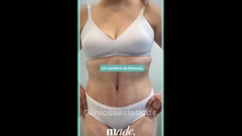Abdominoplastía - Made