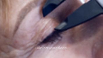 Blefaroplastia - Clínica de la Figura