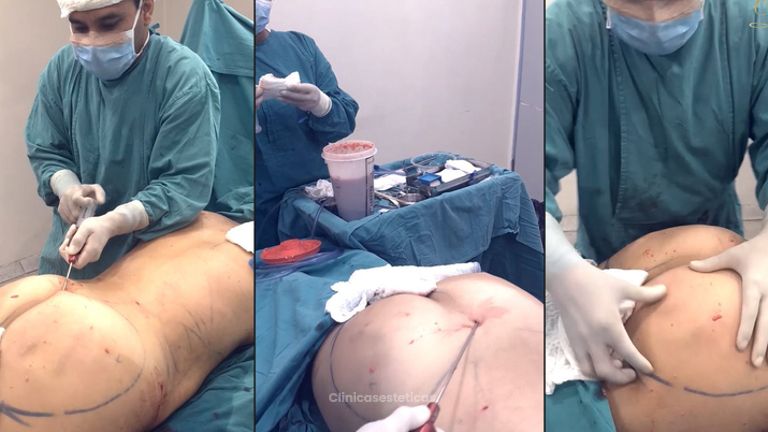 Lipoescultura 