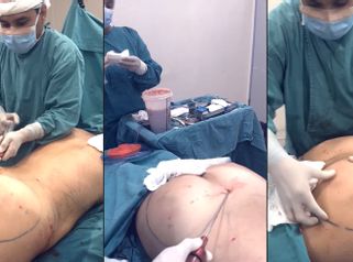 Lipoescultura 