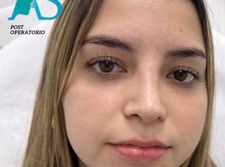 Rinoplastia - Dra. Angélica Sifontes Muñoz