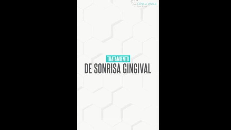 Sonrisa gingival - Clínica Visage