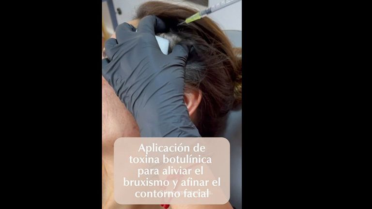 Toxina Botulinica - Clinica Naves