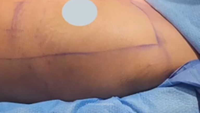 Aumento mamario - Dr. Nadir Carda