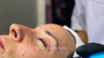 Rejuvenecimiento Facial - Amarna