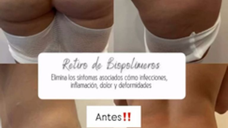 Retiro de Biopolímeros - Dr. Guillermo Santana