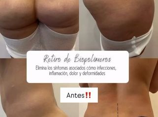 Retiro de Biopolímeros - Dr. Guillermo Santana