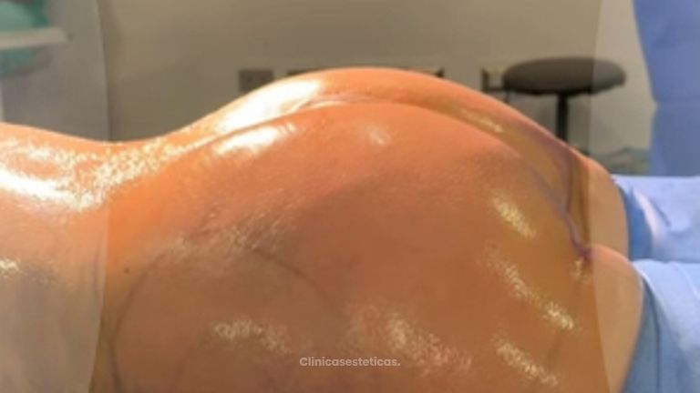 Transferencia de grasa a glúteos -Cirugía Plástica Dieppa