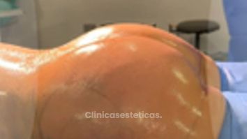 Transferencia de grasa a glúteos -Cirugía Plástica Dieppa