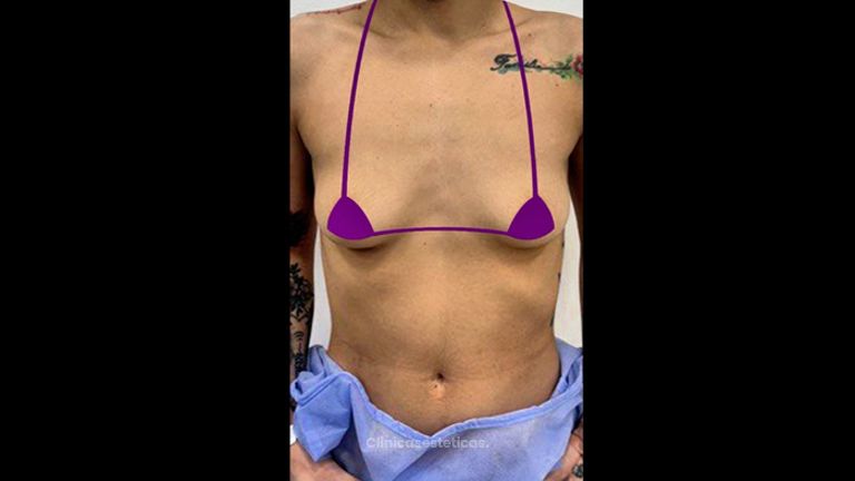 Aumento mamario - Clínica Anastasia