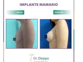 Aumento mamario - Cirugía Plástica Dieppa